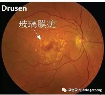 招飞体检眼科常见异常玻璃膜疣