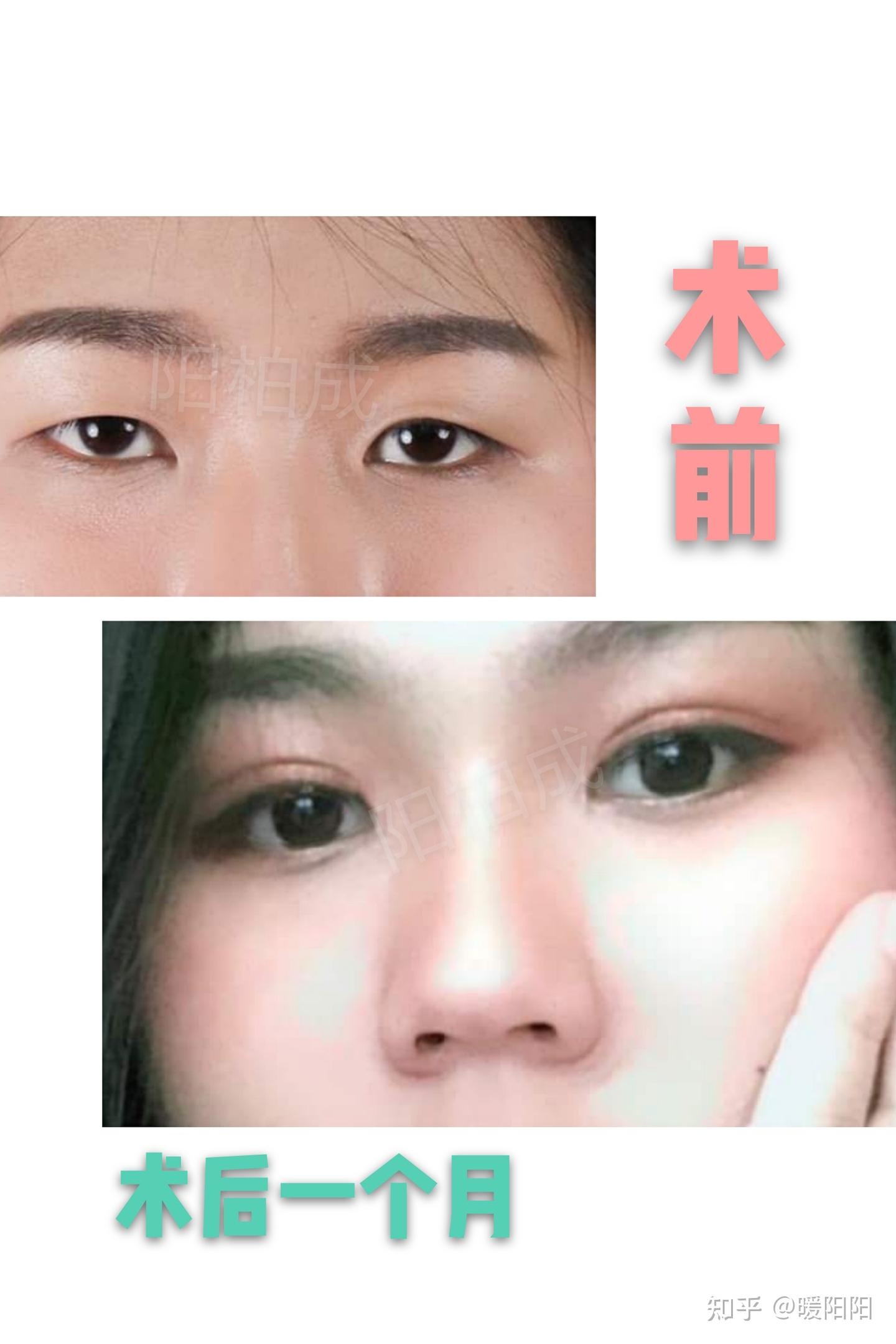 厦门双眼皮案例分享 - 知乎
