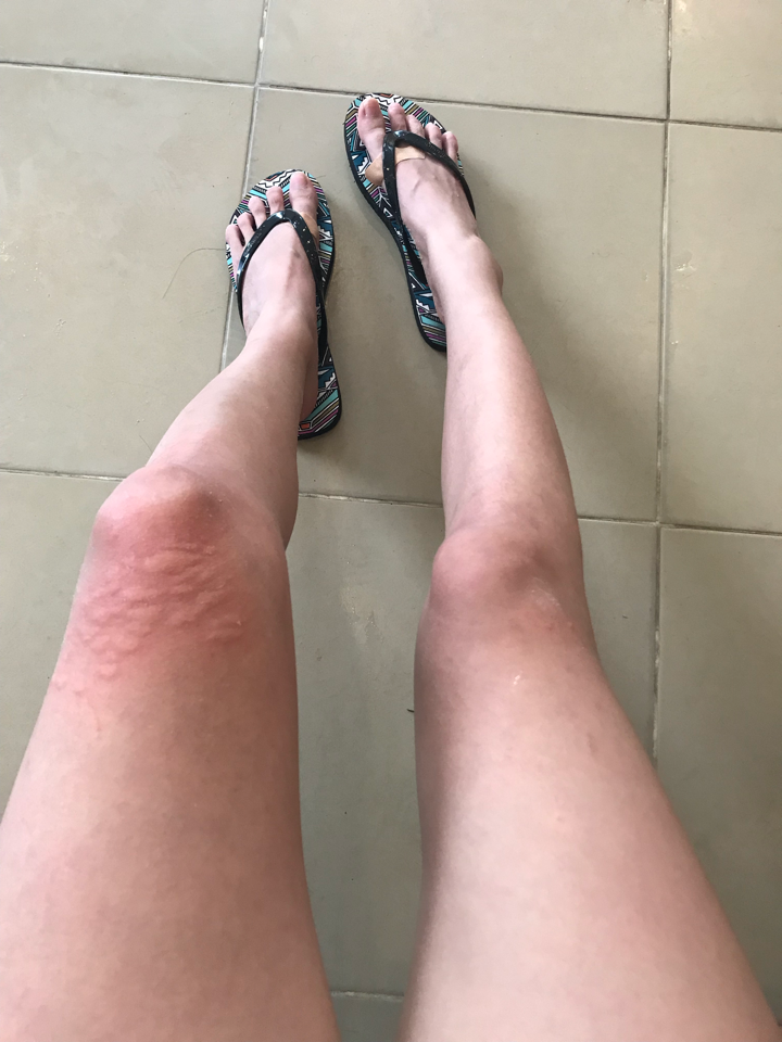 被水母蛰是一种什么体验?