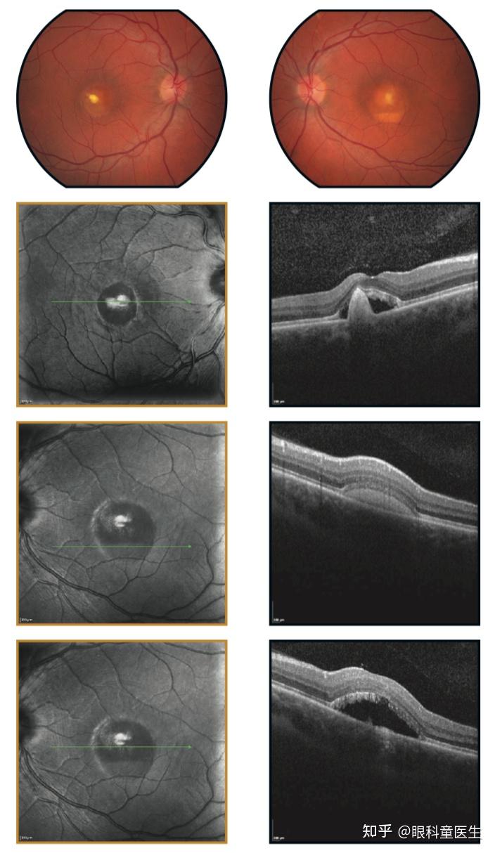 视网膜格子样变性照片图片