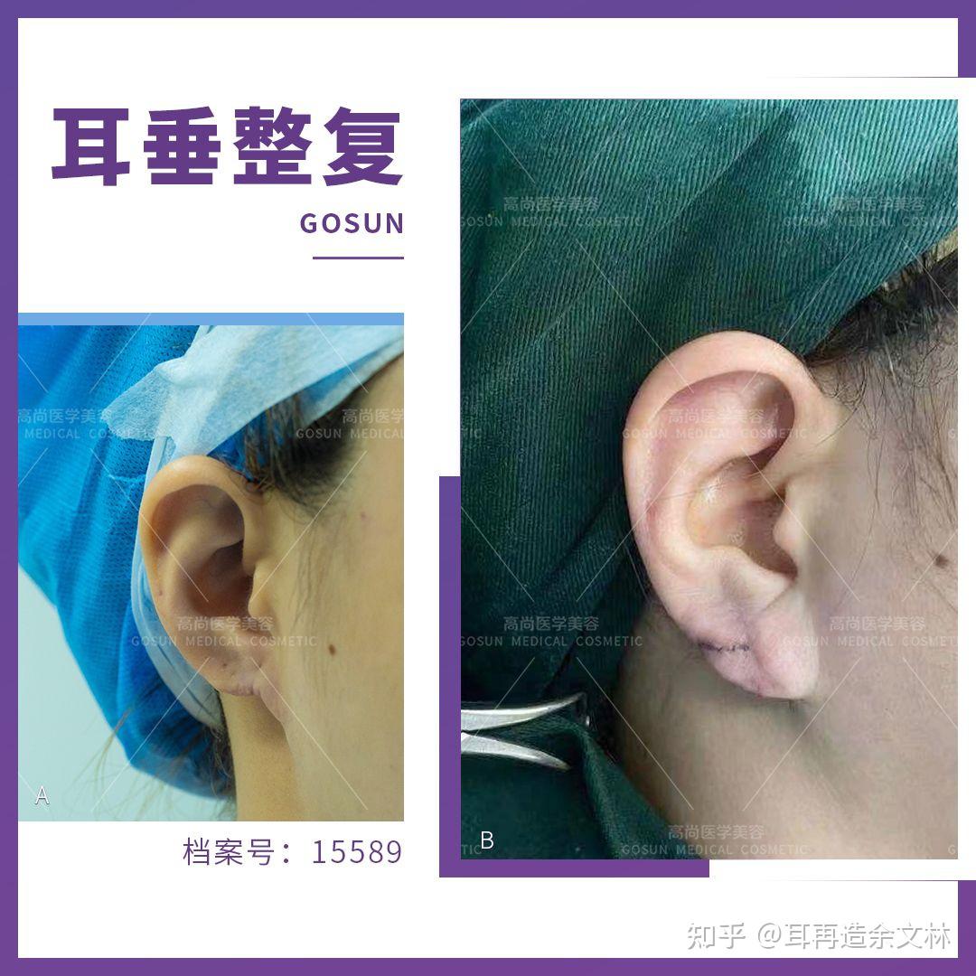 (一)耳廓表面解剖-全科医师针灸治疗-医学