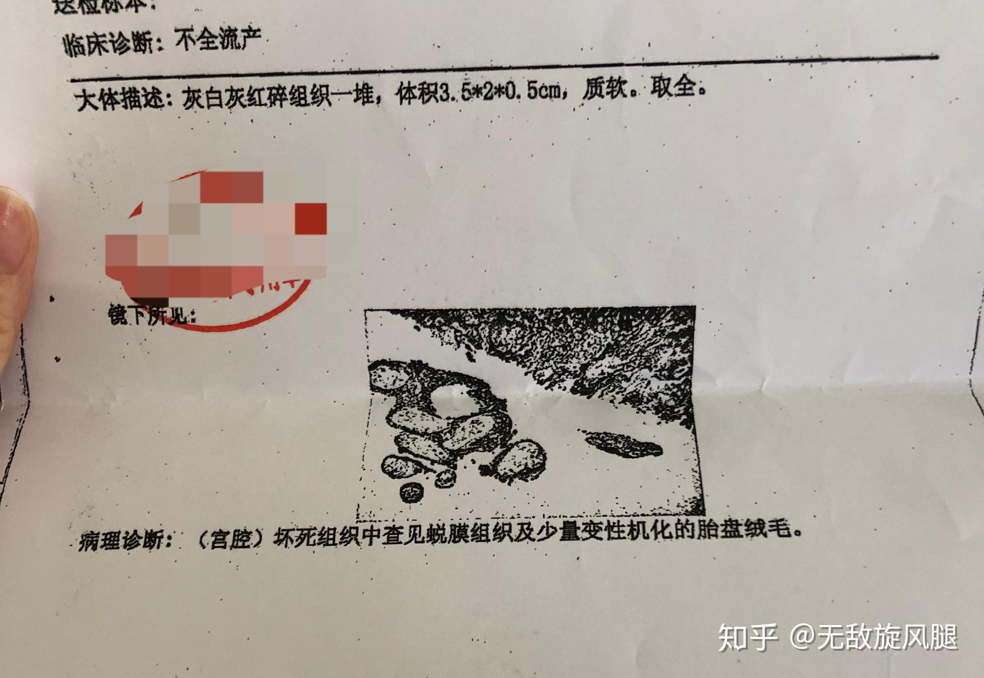 關於藥流不全和宮腔鏡清宮想要告訴你