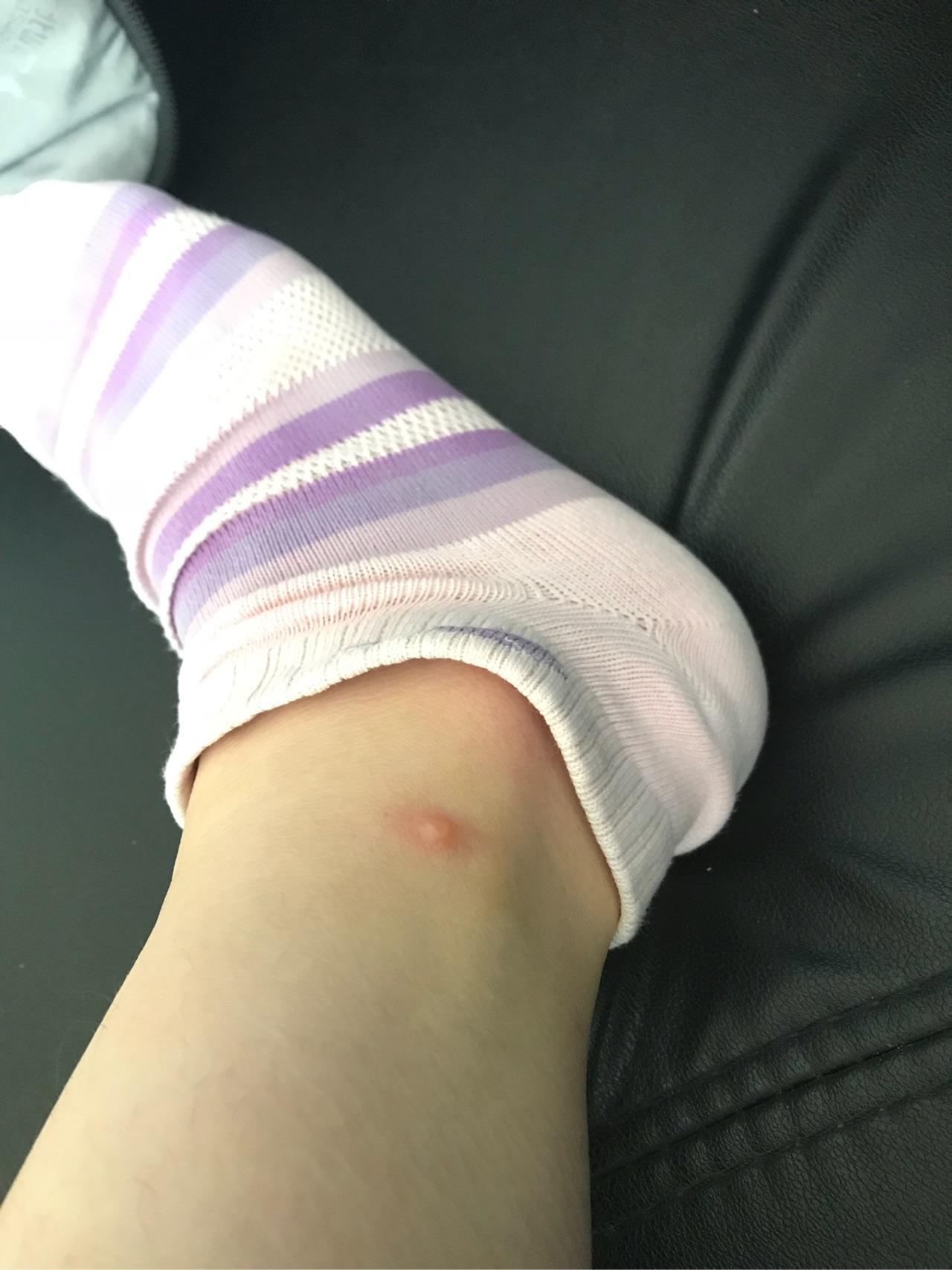 被毒蚊子咬了 肿了很大一个包 还很硬 之后肿的包上面起了水泡 挑破