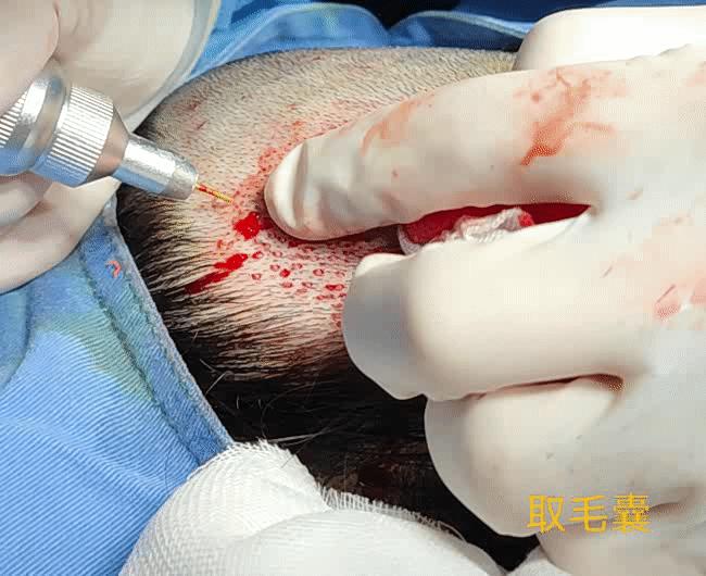 著名整形医生曹思佳去种头发了