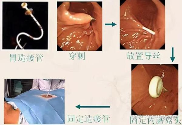 名医专访上海交大附属第六人民医院贾震易经皮内镜胃造瘘术