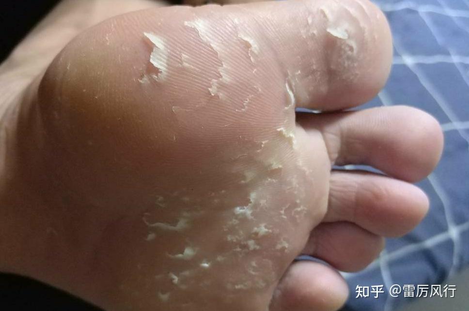 两只脚的脚底都严重脱皮怎么办