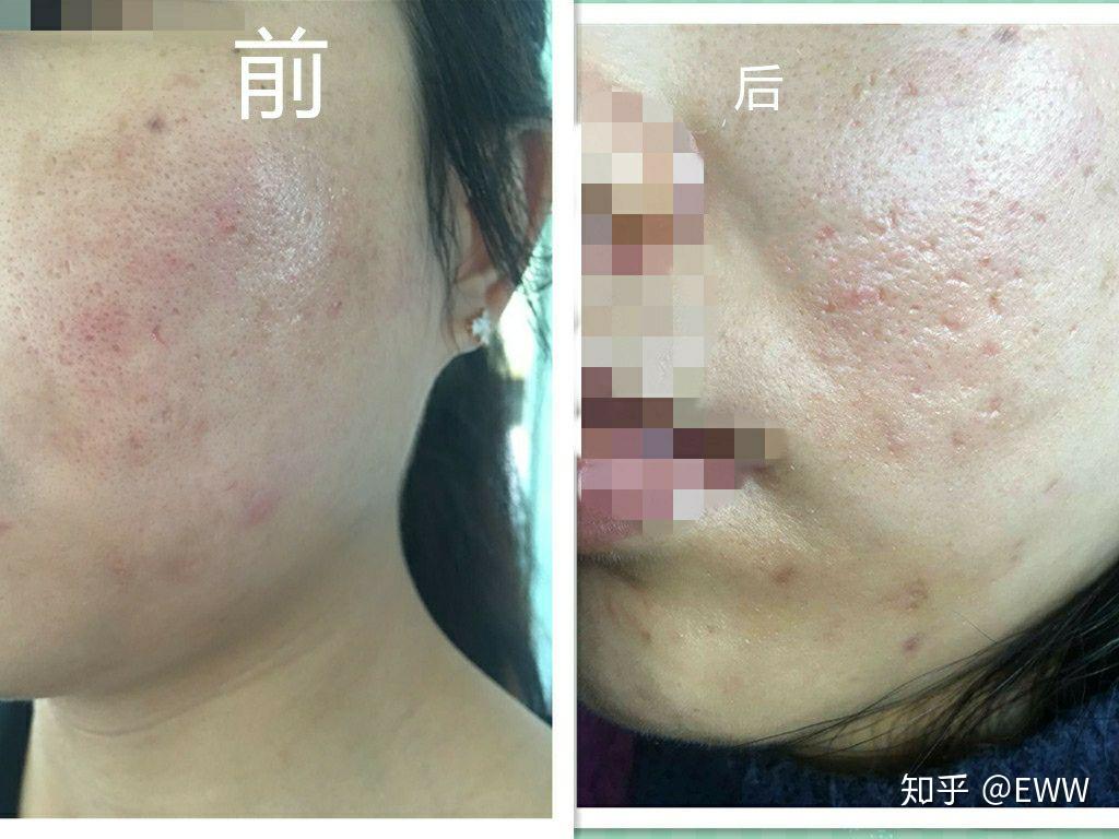 點陣激光去痘坑的效果如何