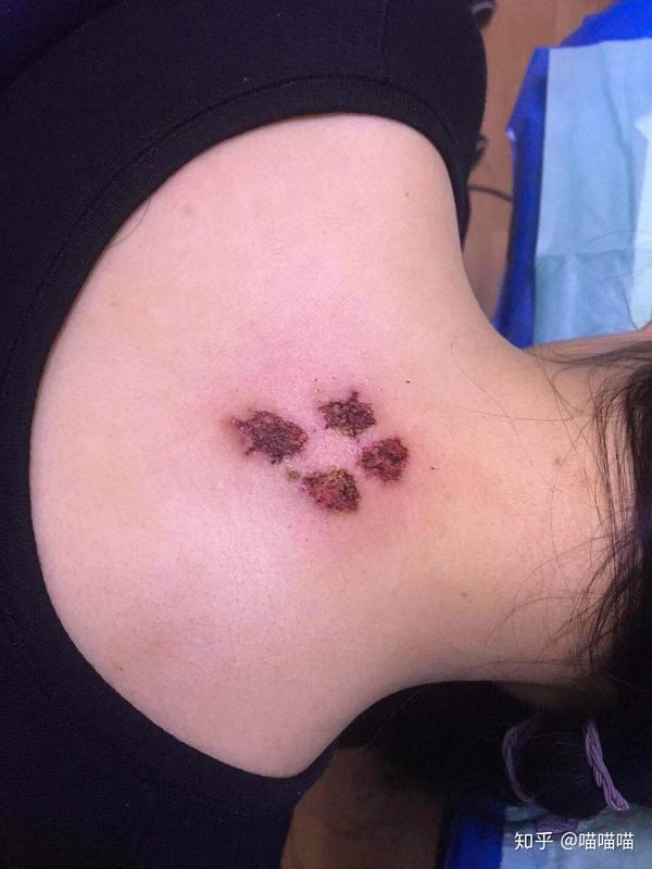 分享一下我激光洗纹身的过程彩色