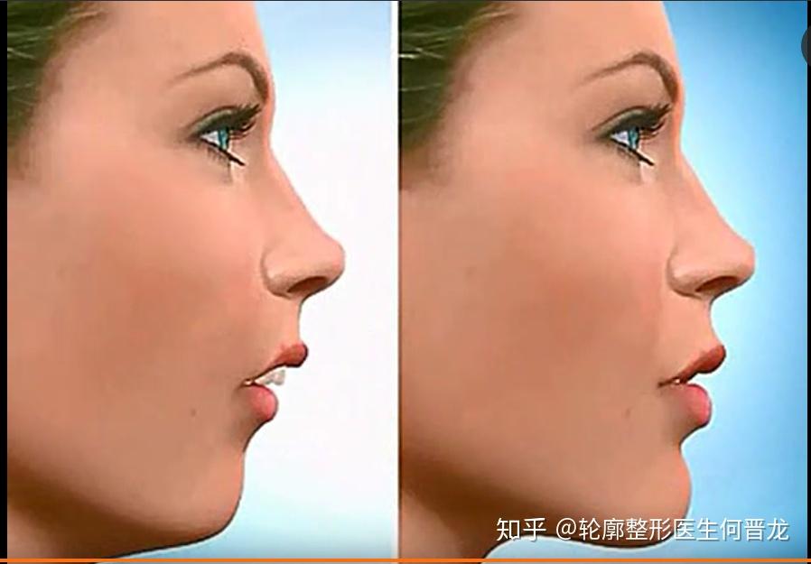 凸嘴下巴后缩如何改善