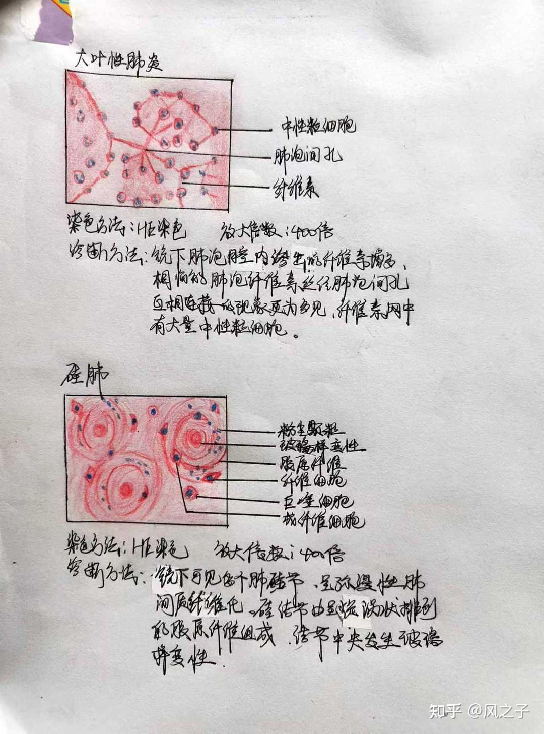 肺脓肿病理切片手绘图图片