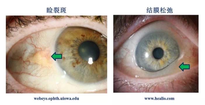 结膜下出血与眼科疾病