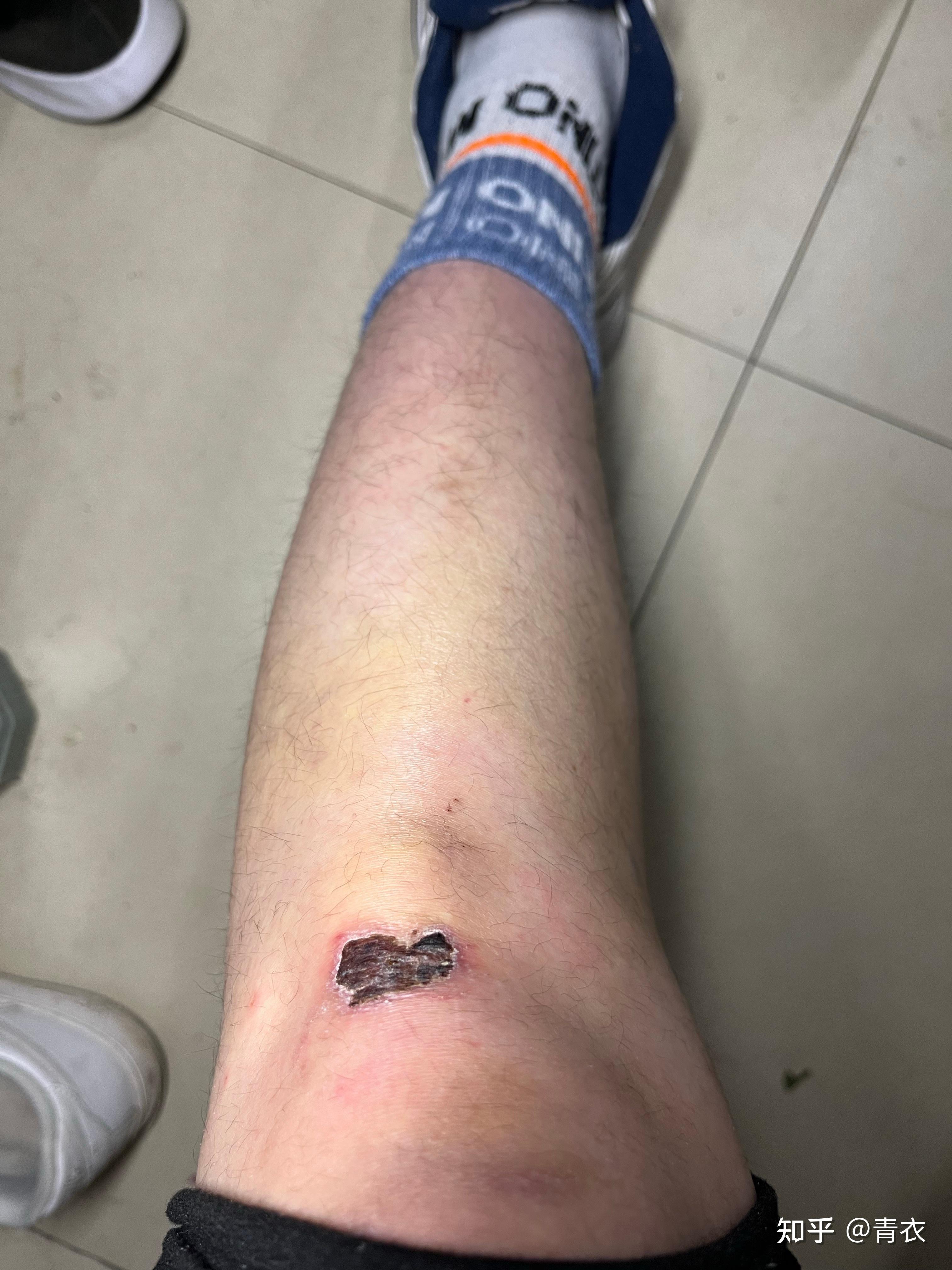 腿摔着了 膝盖下面胫骨的地方肿了个硬包