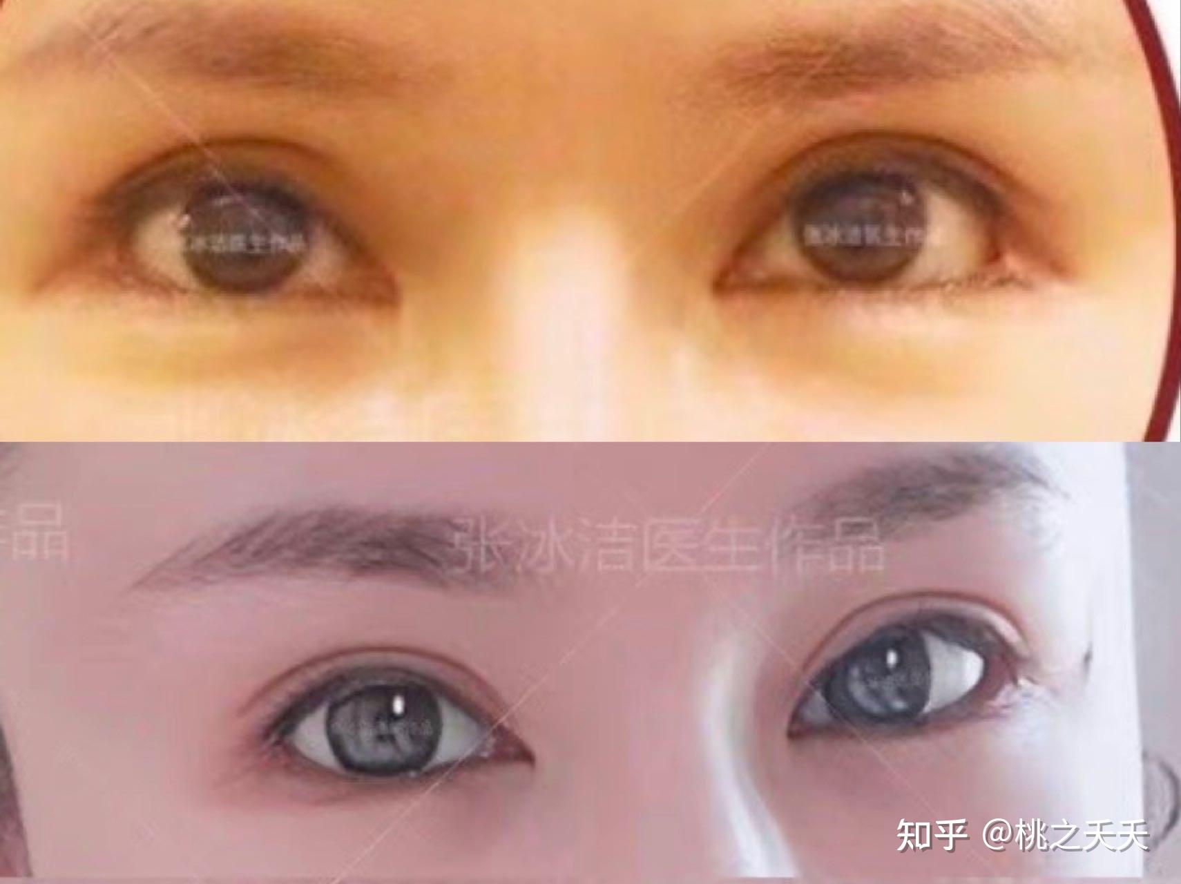 [cp]中国最好的双眼皮眼部整形眼修复专家：闫迎军（简介、案例、预约） - 知乎