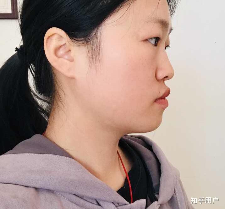 本人23,女,骨性地包天可以通过牙齿矫正来调整