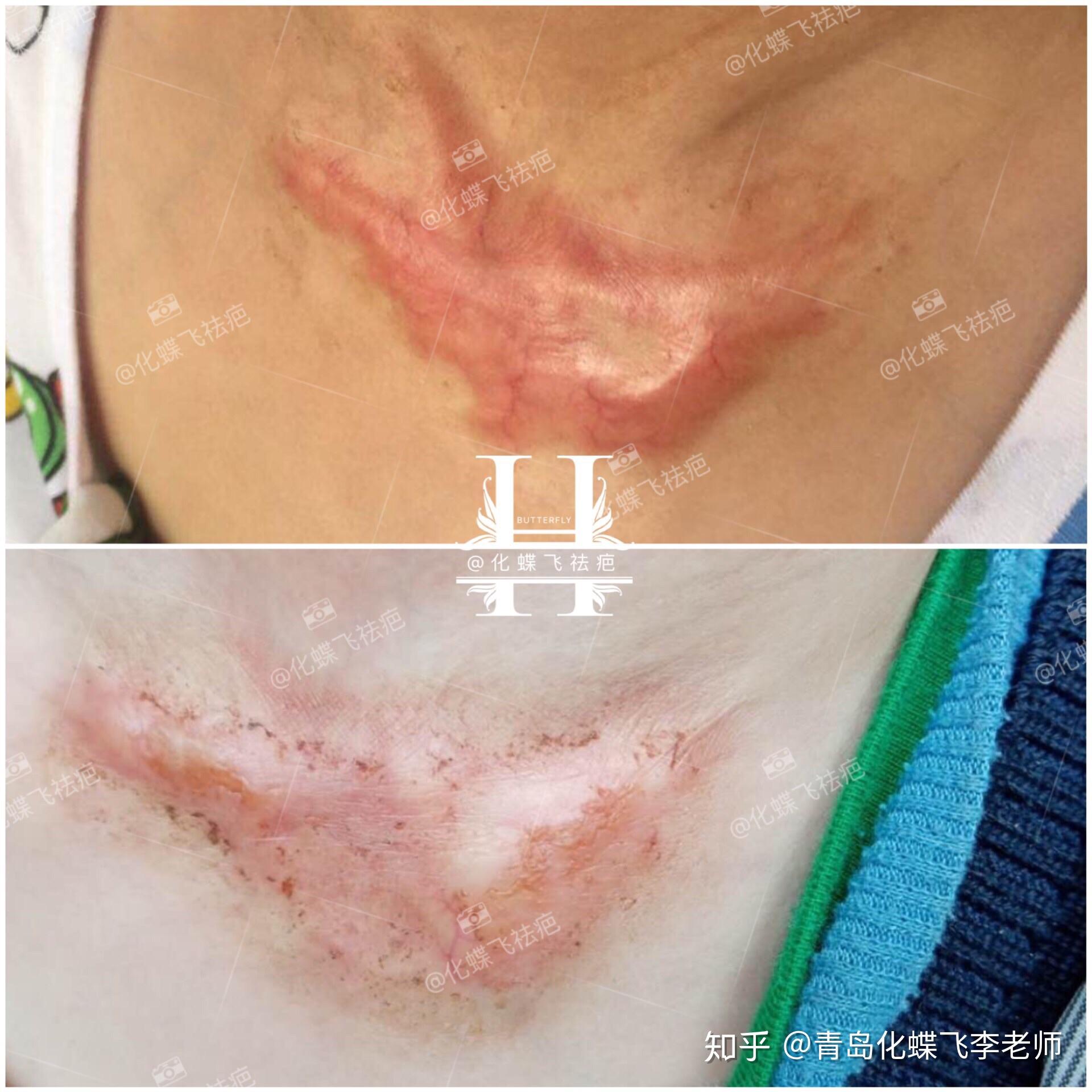 小宝宝胸前烫伤增生疤痕,中药修复效果不错
