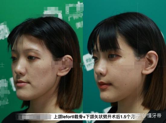 下面一起来参考两个正颌的案例