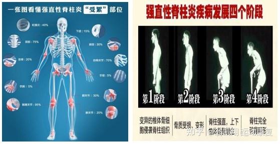 強直性脊柱炎早期有哪些預警信號