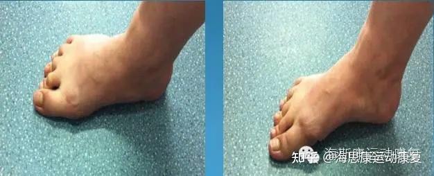 千里之行始于足下足型对跑步的影响一拇外翻