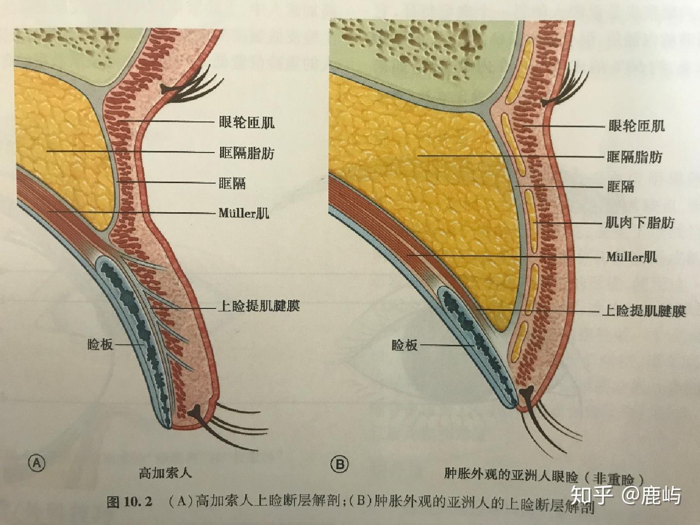 想做双眼皮手术种类那么多我该选哪种