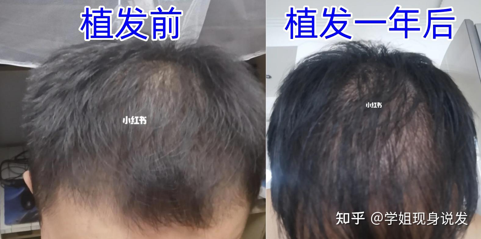 为什么植发会失败？别被坑了，或许你根本不适合植发！满足植发条件的前提下，如何找到一位植发技术水平高、审美优秀的医生，降低植发失败概率？分享选 ...