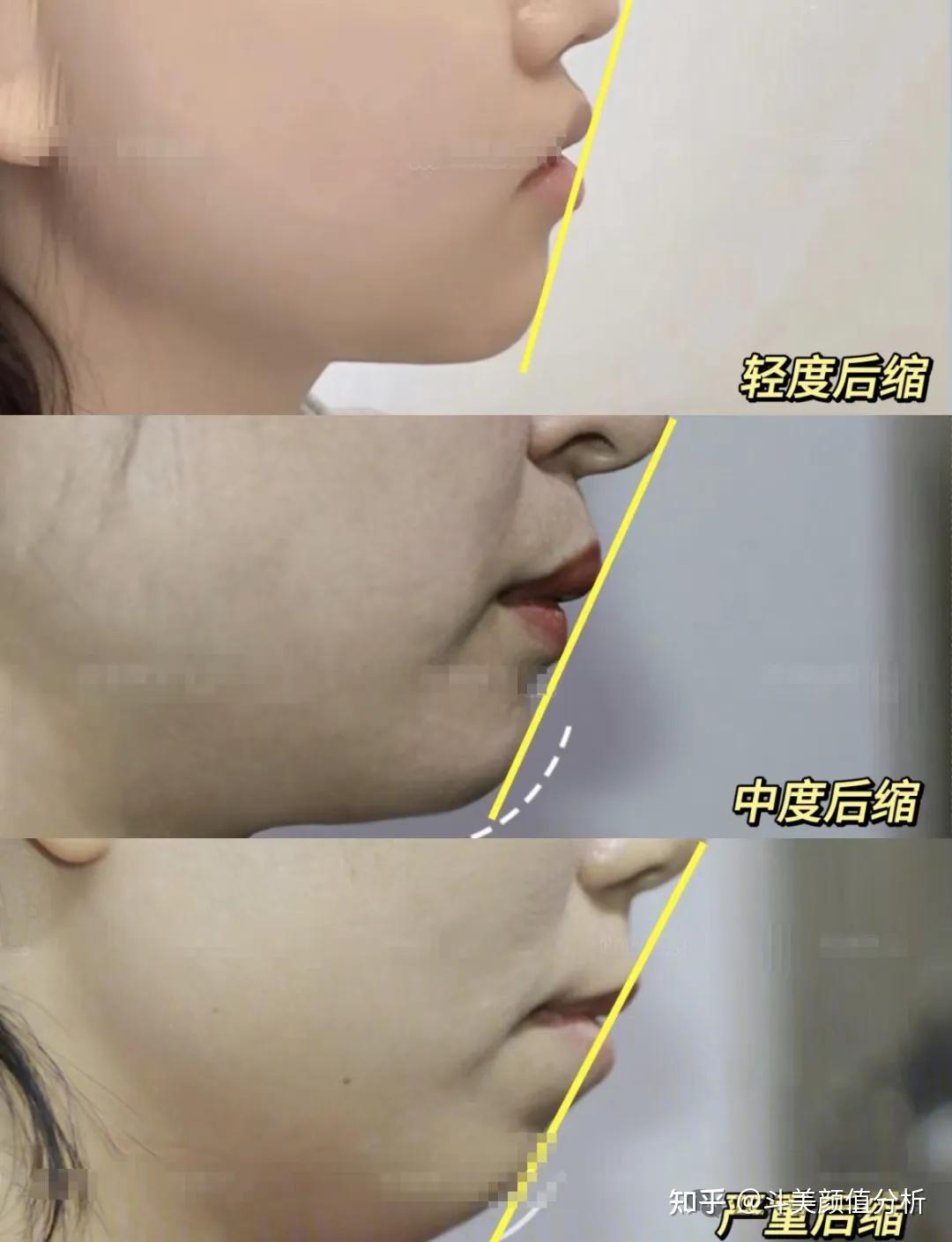 下巴后缩很丑怎么办?下巴后缩做正颌还是垫下巴好…