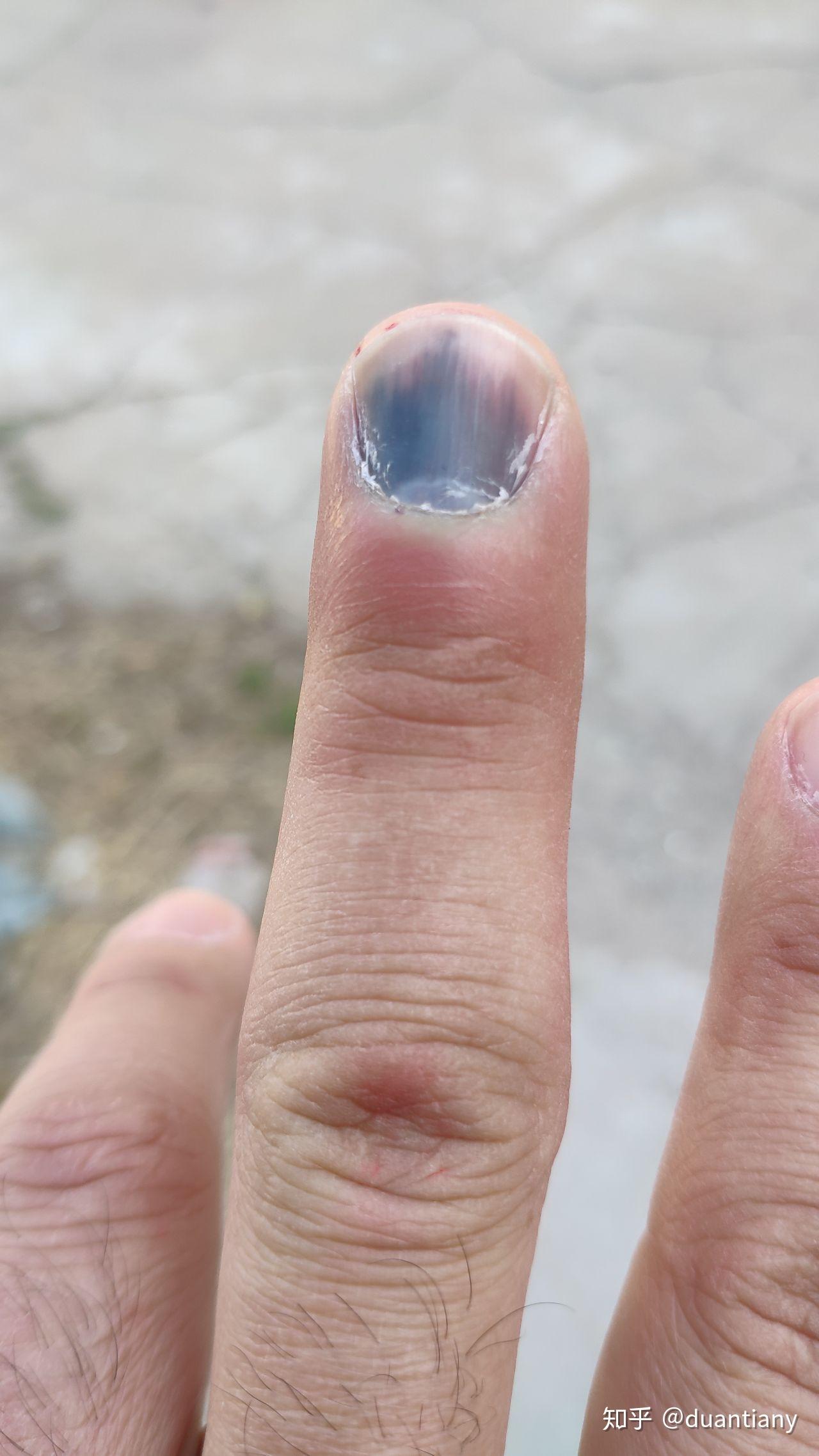 指甲被车门挤伤 指尖全是淤血 怎么办? - 知乎