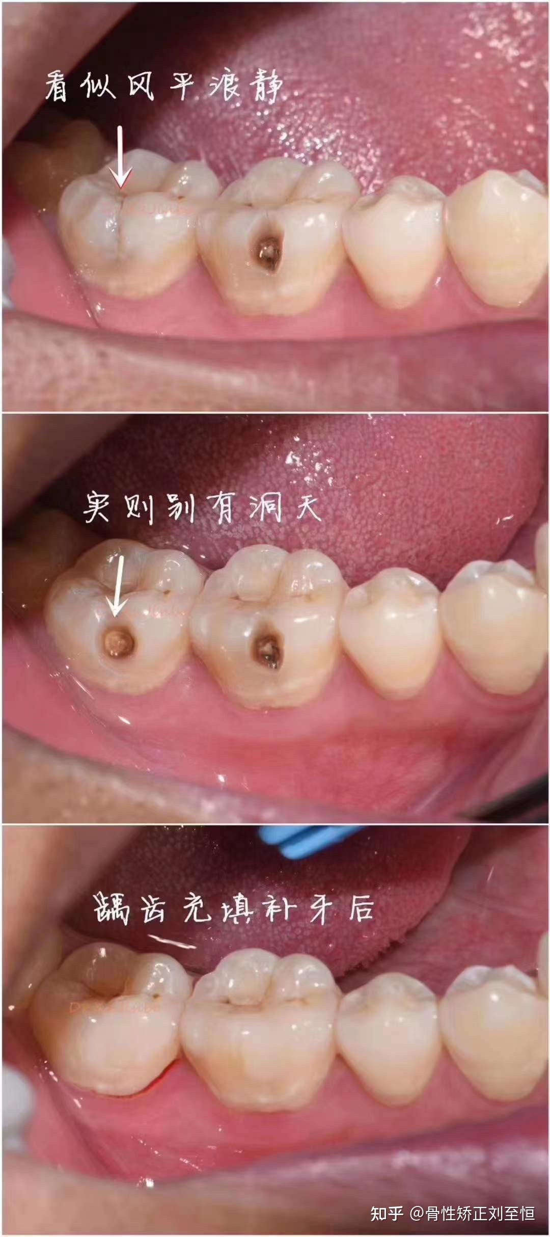 侧切牙蛀牙图片