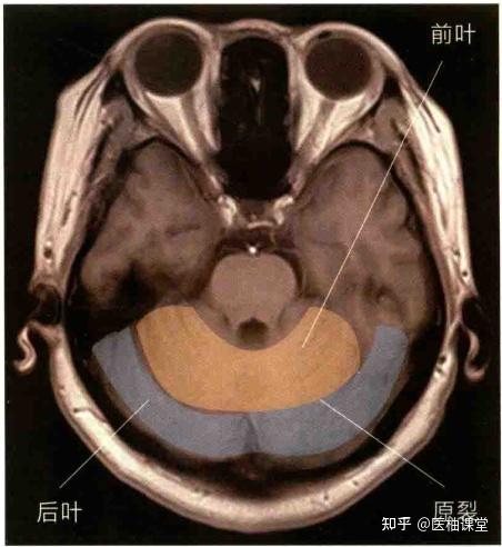 小脑表面的沟裂
