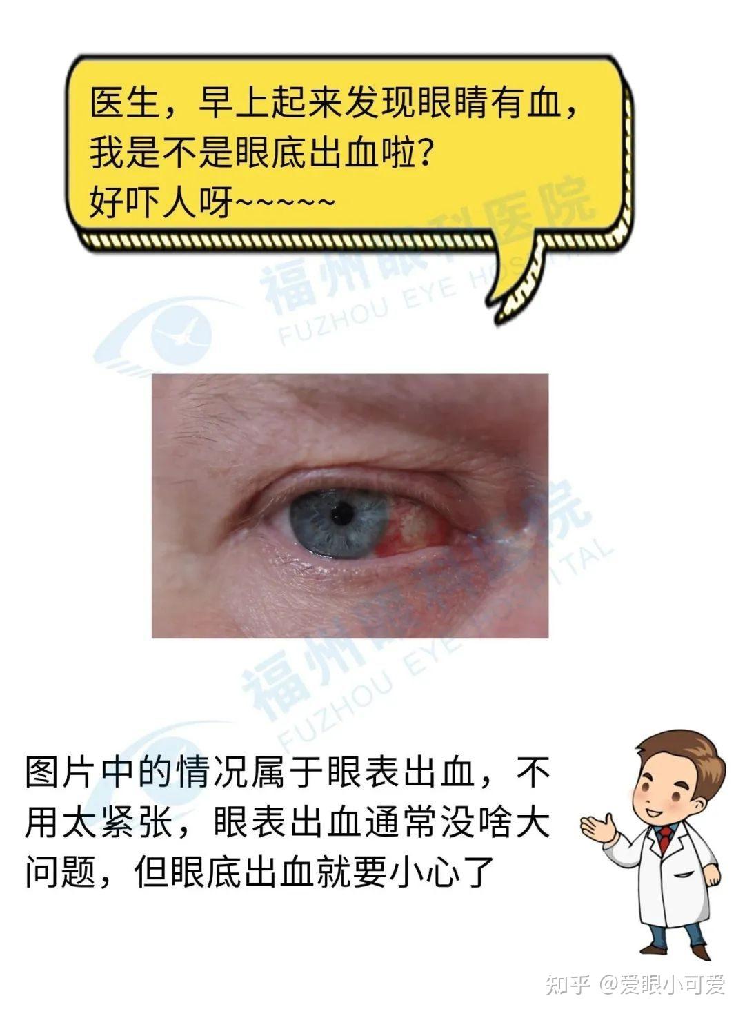 眼睛出血?别慌 先分清眼表还是眼底