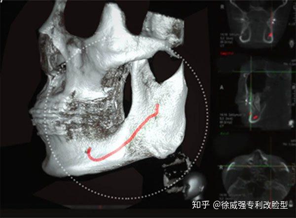 进行头颅正侧位和下颌曲面断层检测,检测下颌骨及神经管的情况,进行