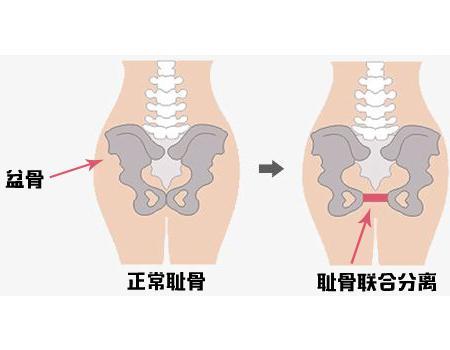 有一种产后疼痛 叫耻骨联合分离 知乎