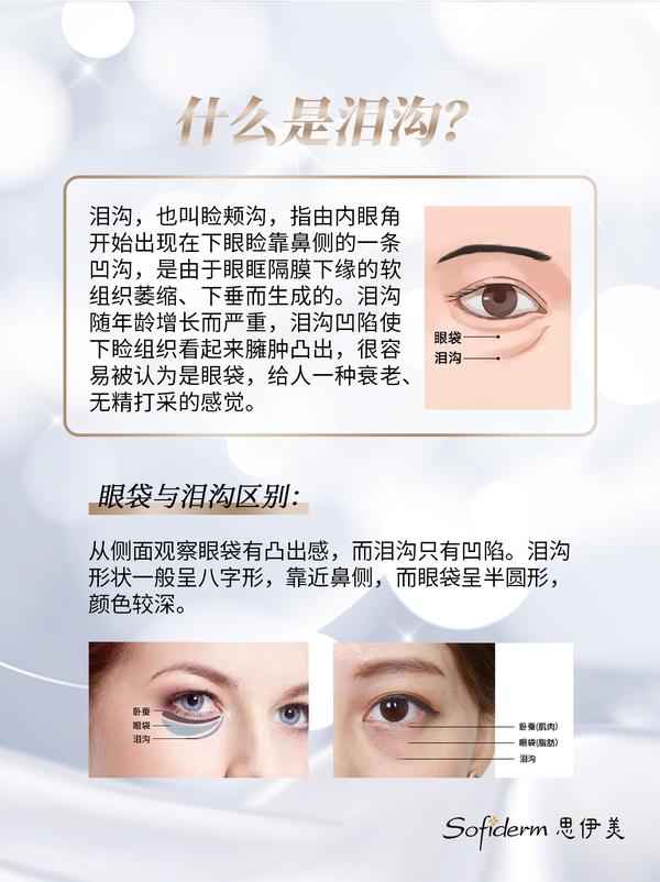 泪沟凹陷怎么办?抗衰路上思伊美玻尿酸来改善 - 知乎