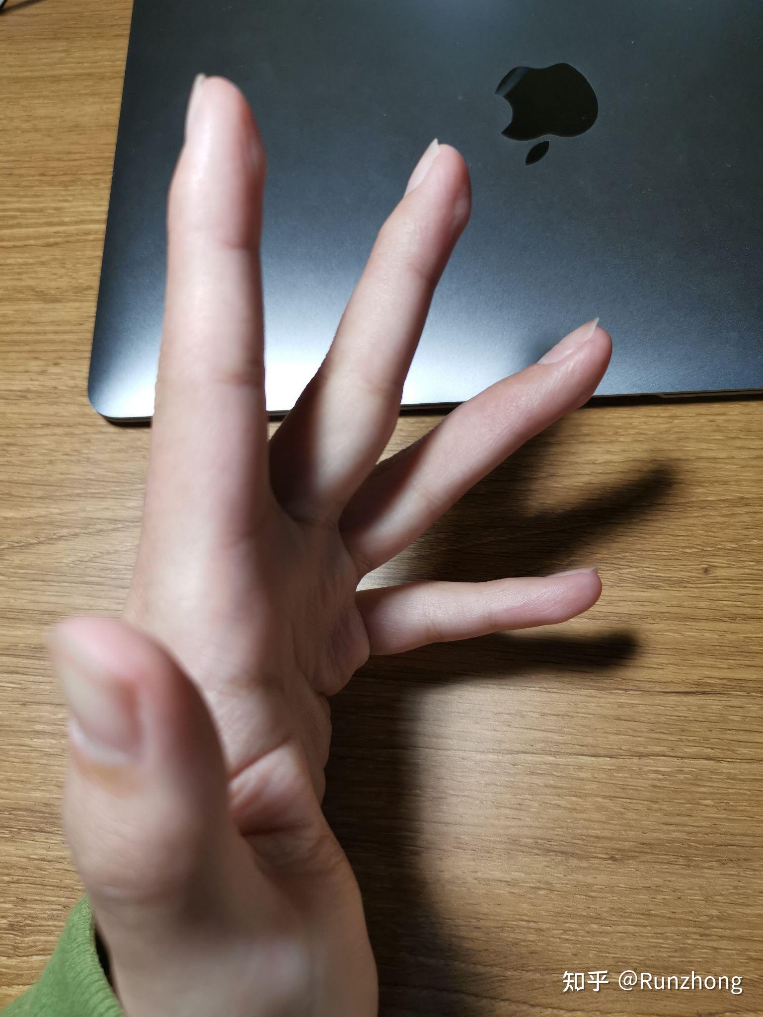 锤状指病情记录