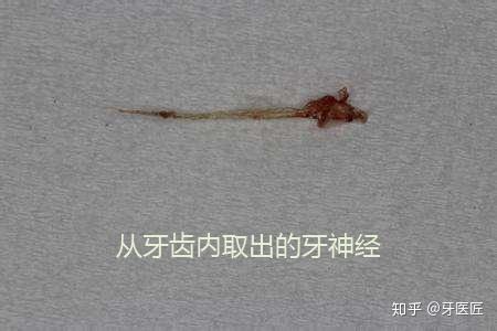 什么情况下需要杀牙神经?