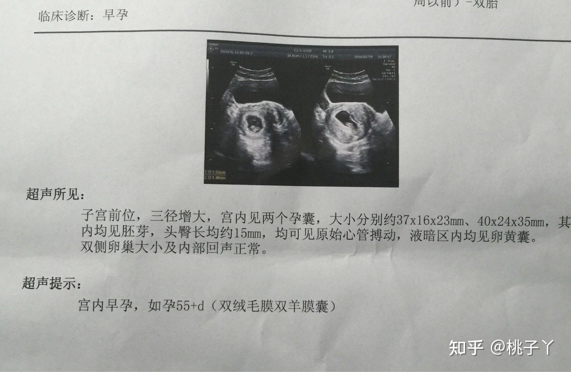胎心正常值|宝宝胎心监测、多长时间有胎心，胎心监护的作用_安贝乐育婴网