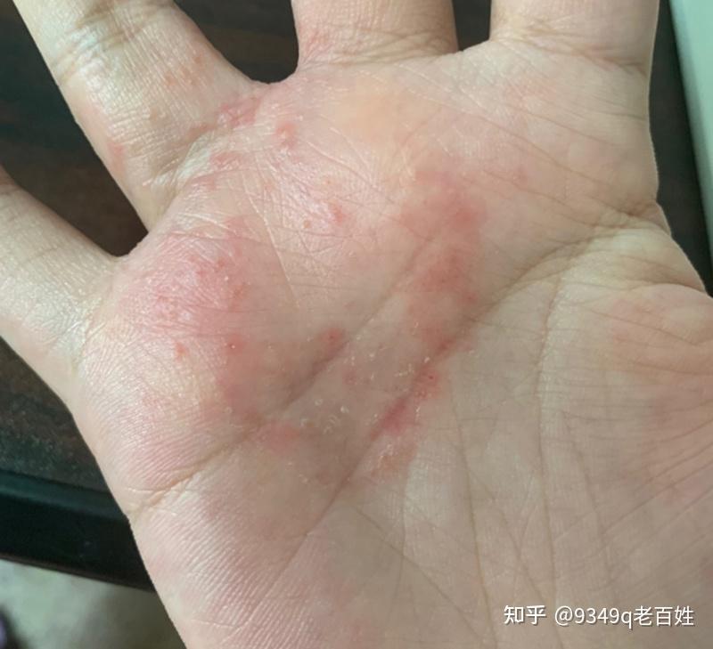 湿疹怎么根治?根本的原因是什么