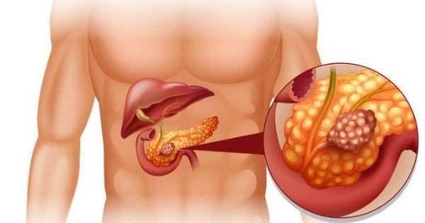 又一位企業家得胰腺癌去世胰腺癌6大早期症狀一定要警惕