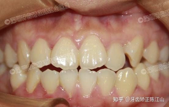 这么多种牙齿畸形不矫正有什么影响吗