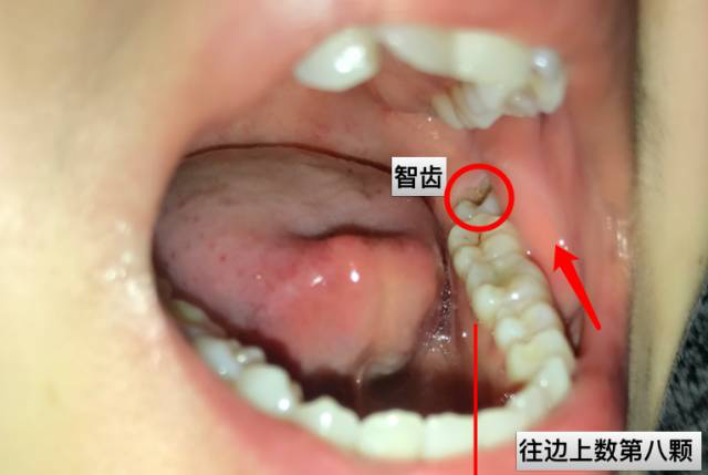 如何防止智齿发炎