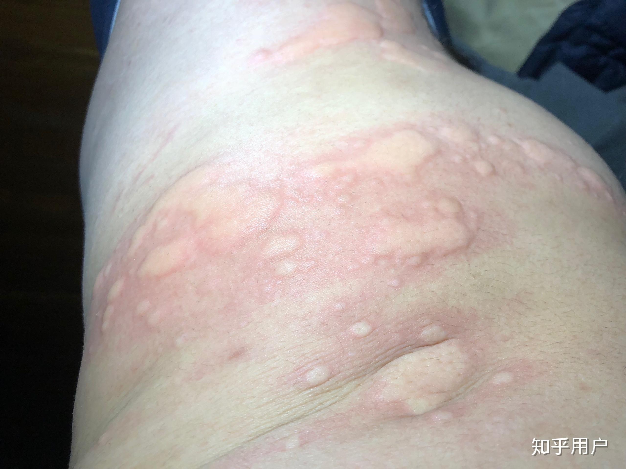 有没有小伙伴和我一样的荨麻疹症状,上图? - 知乎
