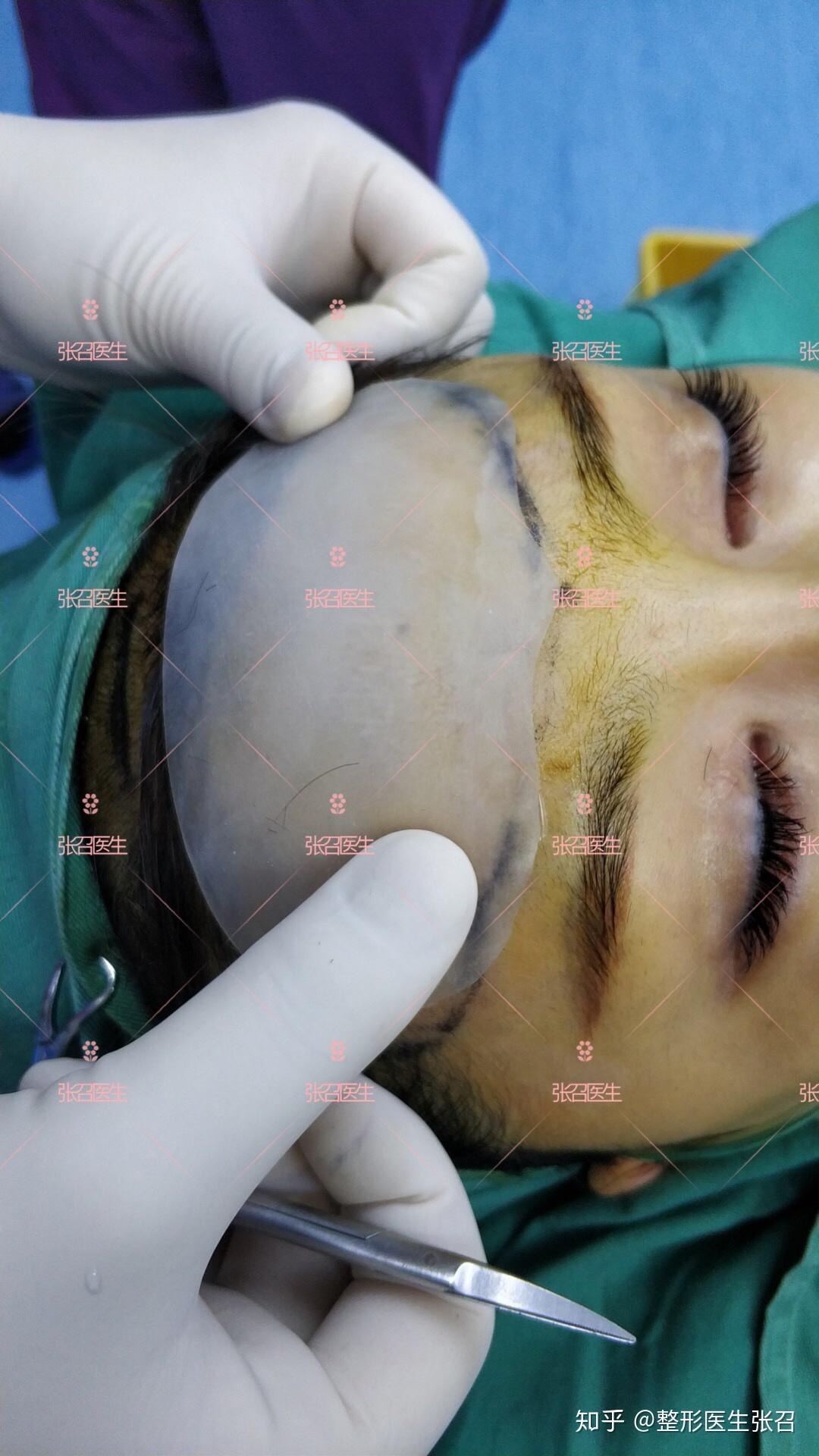 丰额头选择假体还是脂肪