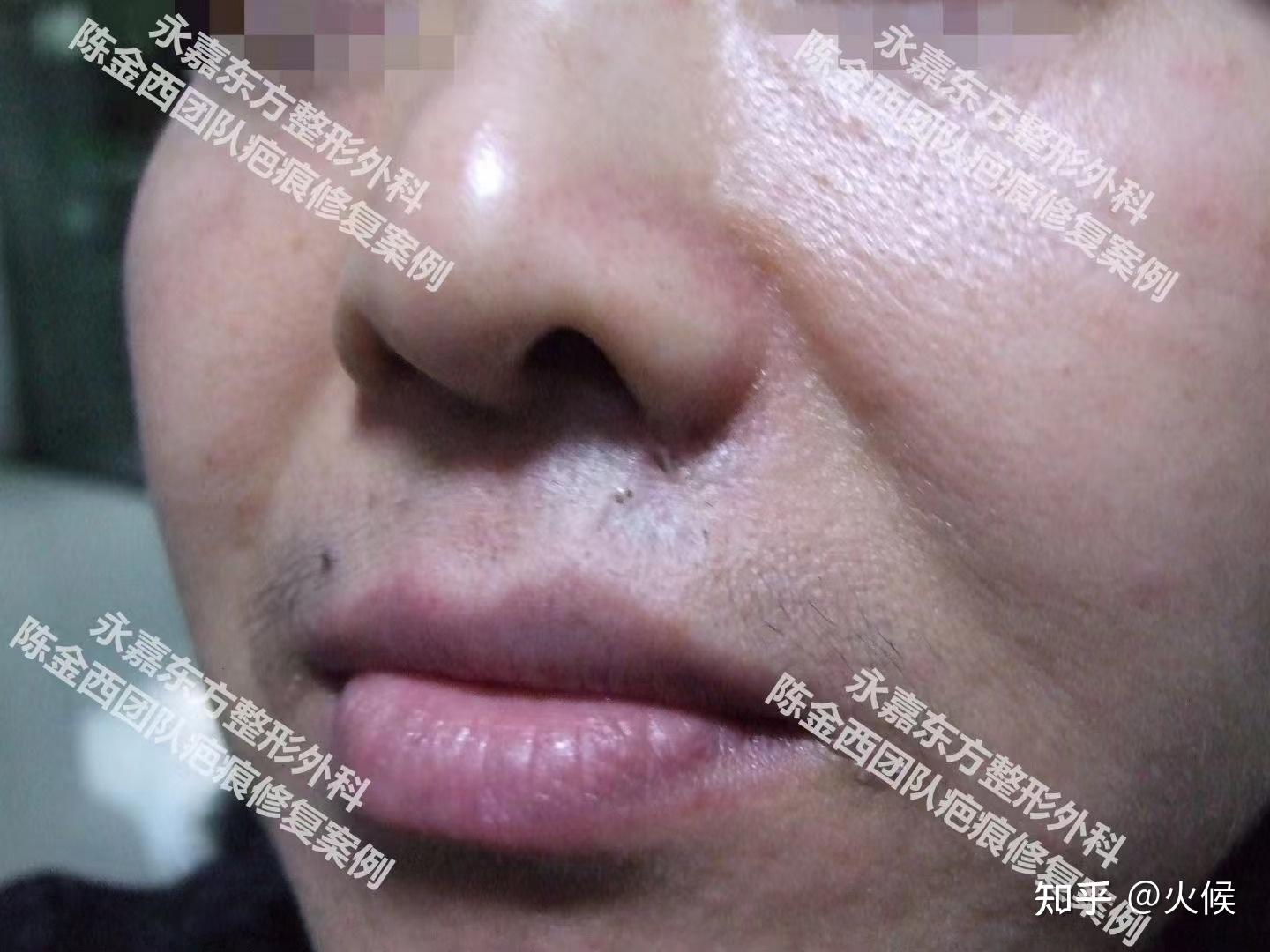 疤痕增生怎么治疗，陈金西治疗的真实案例 - 知乎