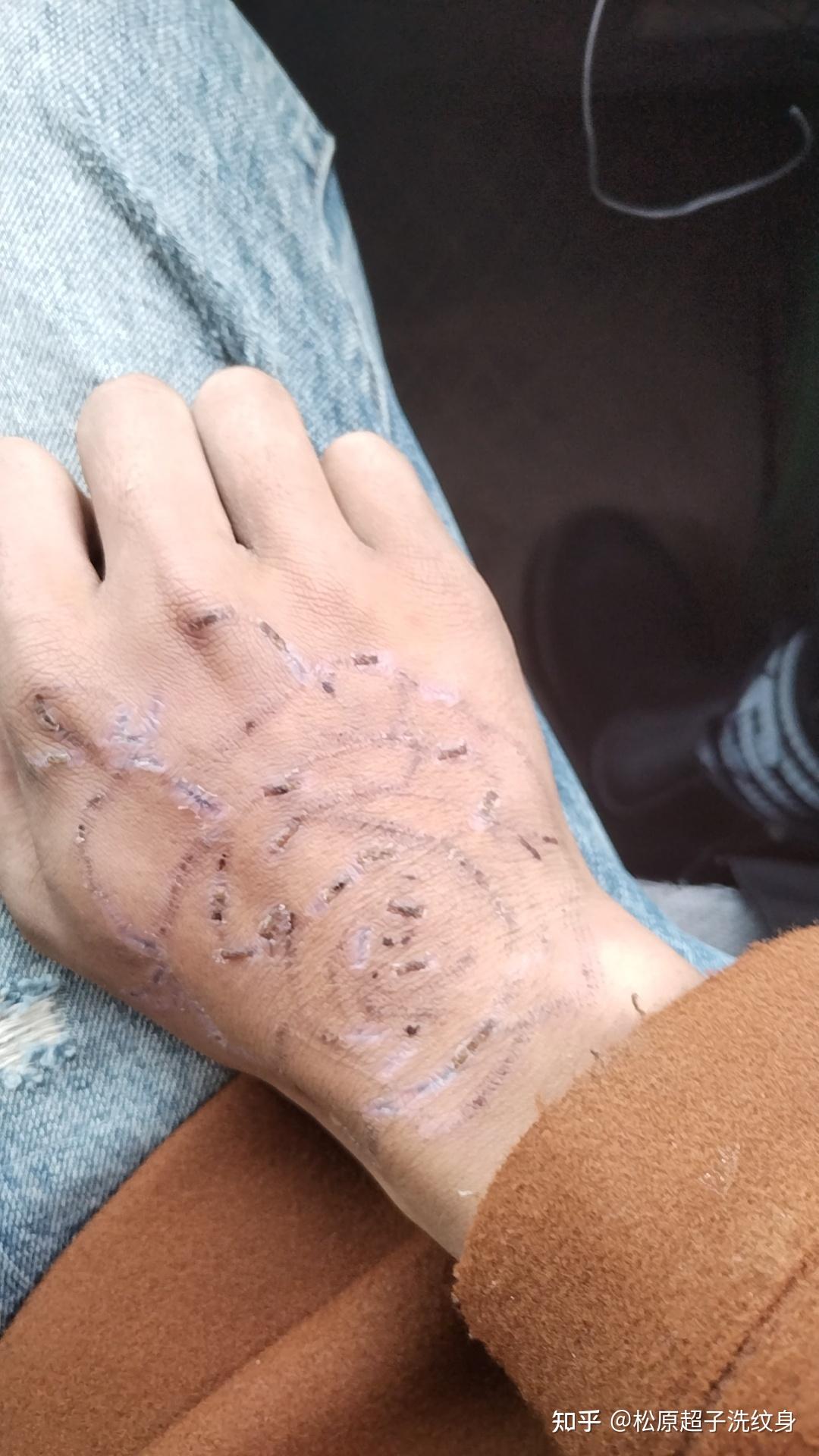 洗纹身的全部过程,清洗进度,抓紧看看吧!松原洗纹身