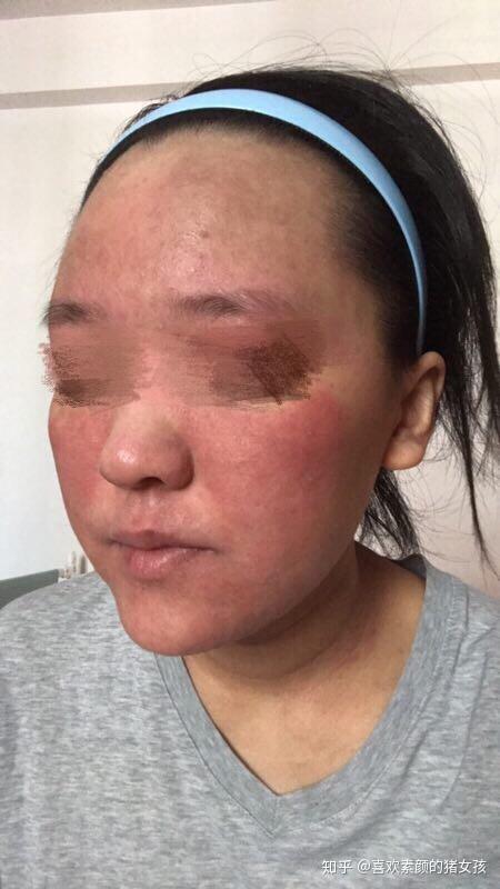 激素依赖性皮炎通常如何治疗? - 知乎