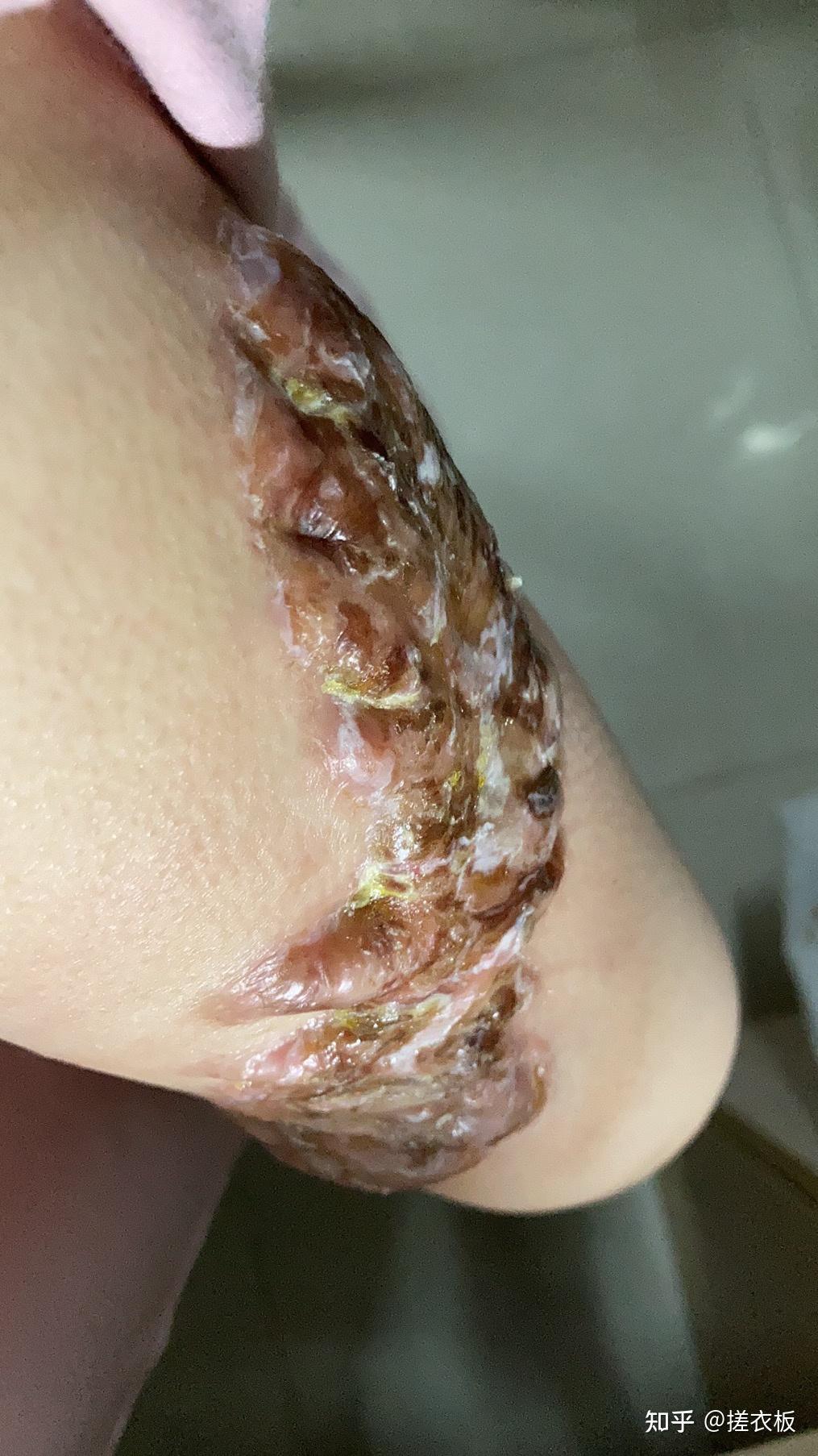 瘢痕体质的人这一生有什么样的体验? - 知乎