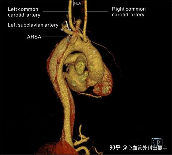 B型主动脉夹层合并迷走右锁骨下动脉 - 知乎