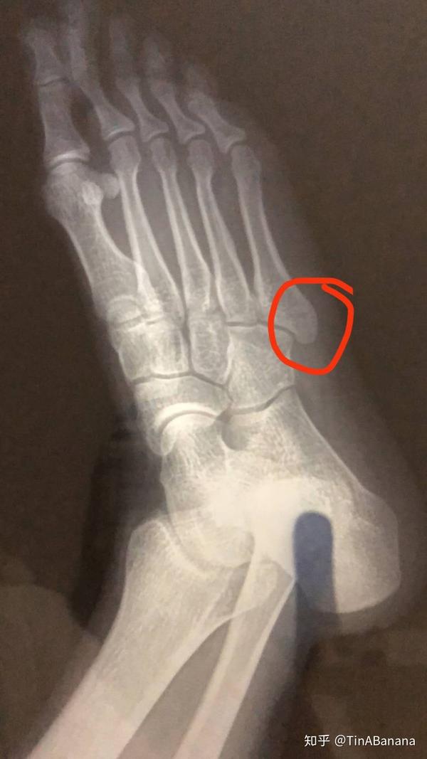 2020右脚骨折恢复记录