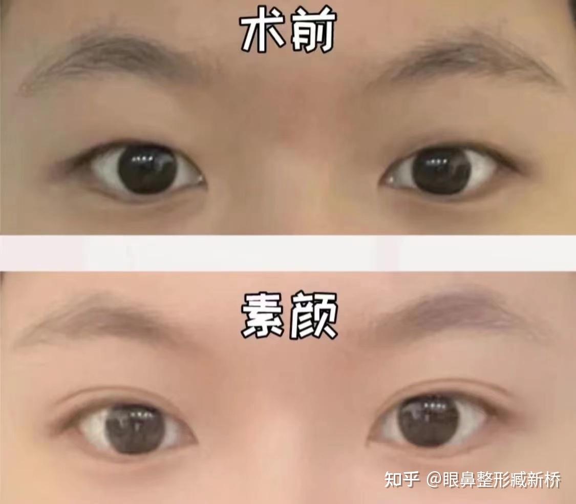 三点式双眼皮（北京医院丁金萍）系列案例六十五 - 知乎