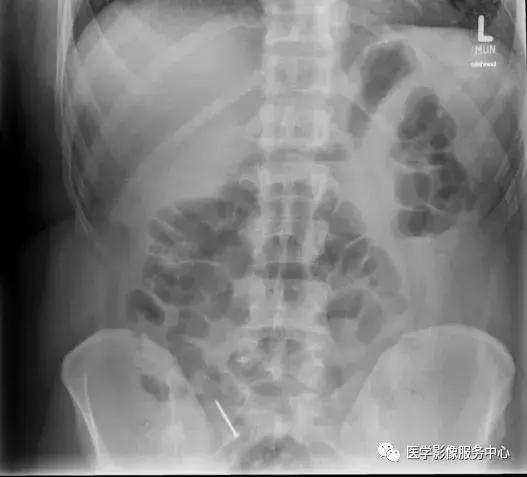 吞入体内的异物多久能排出?X线告诉你真相 - 知乎