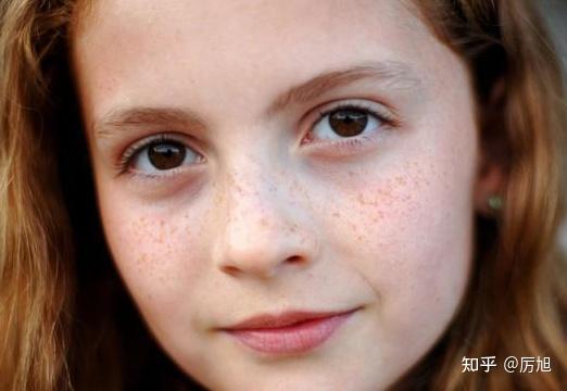 40岁后女性,斑点原来要这样去改善淡化!